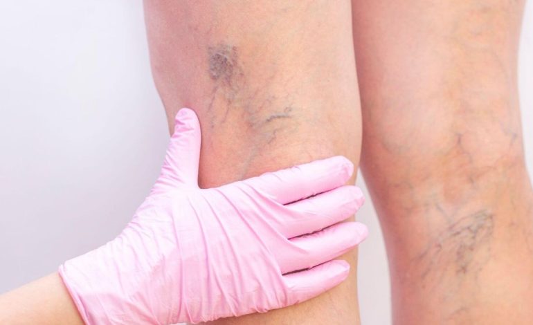 How Early Vein Treatment Can Save You from Serious Health Issues