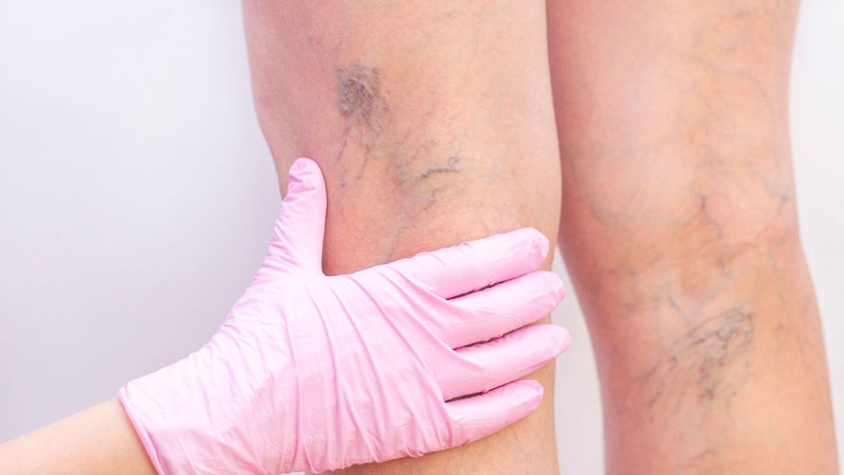 How Early Vein Treatment Can Save You from Serious Health Issues